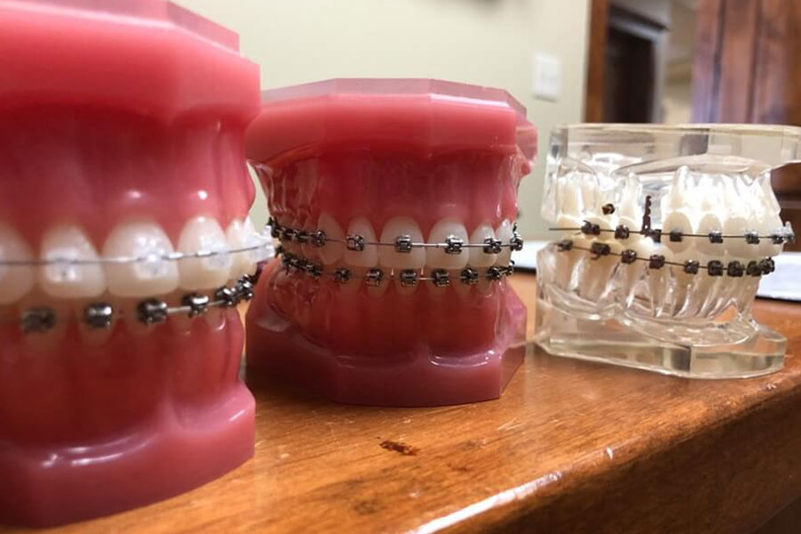 clear braces or metal braces which is better?
