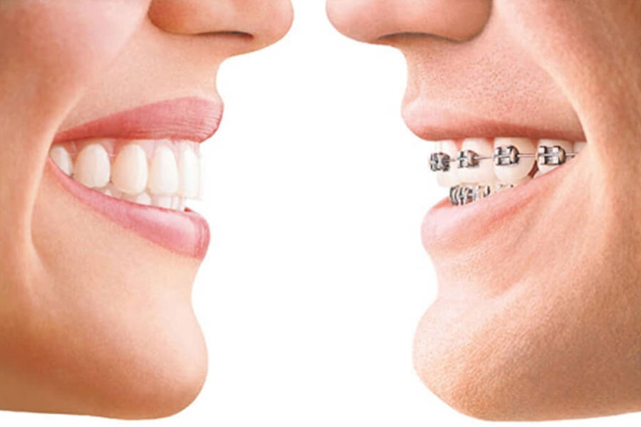 Metal Braces VS Clear Braces
