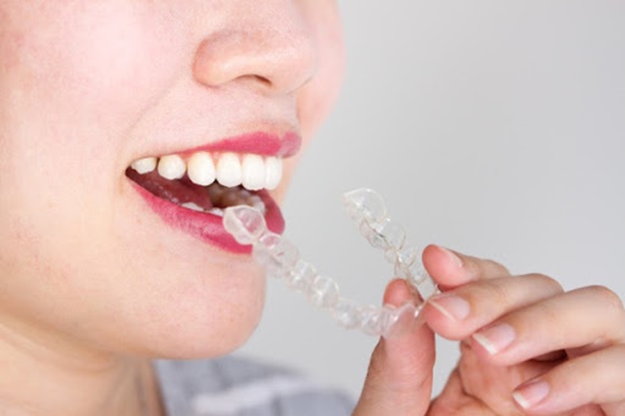 on which aspects getting invisible braces