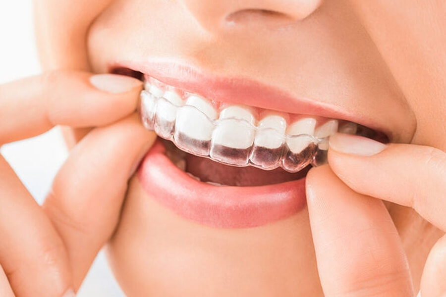 Best Clear Aligners In USA