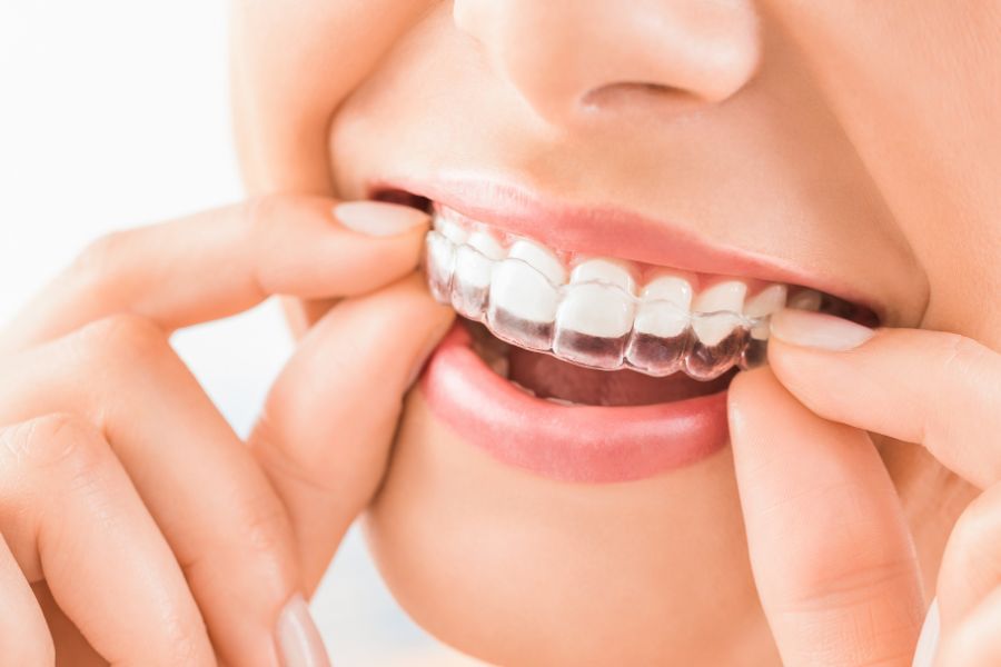 How Much Does Invisalign Cost in Wollongong New South Wales?