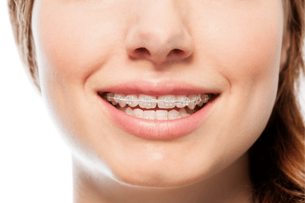 Ceramic Braces for Teeth Straightening