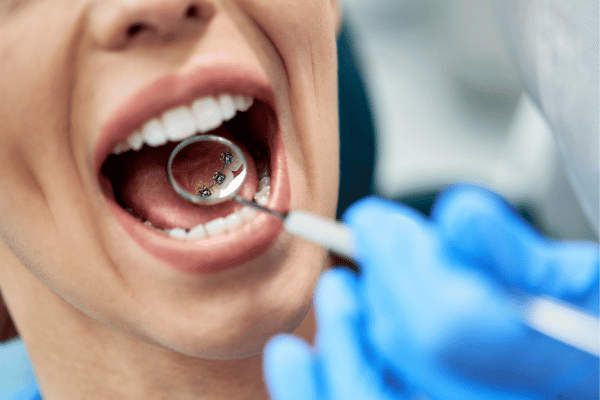 teeth Straightening options as an adult