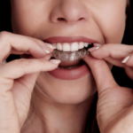 Clear Aligners vs. Braces: The Better Option This Year