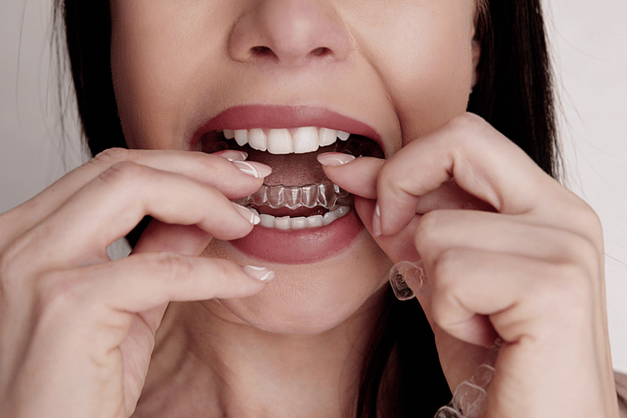Dental clear aligners