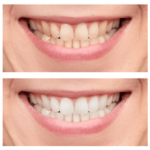 Teeth Whitening Kits: A Comprehensive Guide