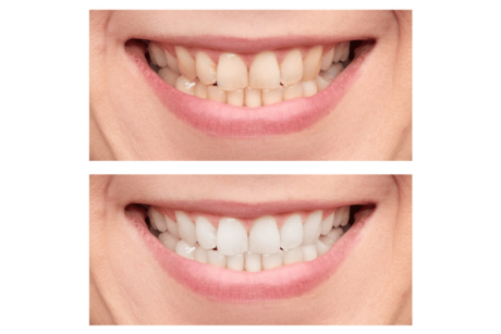 Teeth whitening before and after results