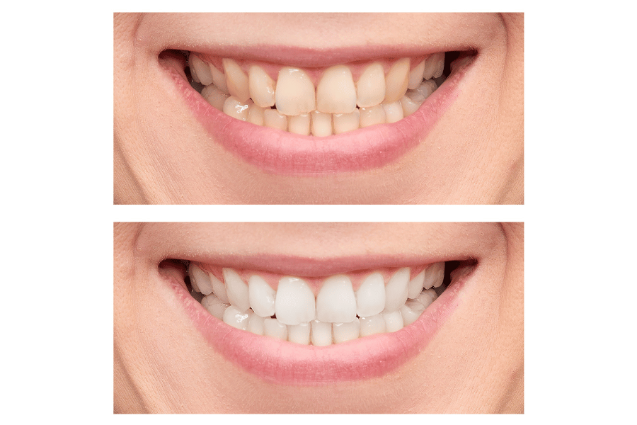 Teeth whitening before and after results